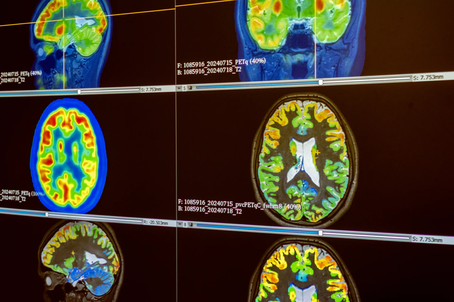 The pvc-PET imaging method relies on the intersection of information from multiple methods. Archive of the Department of Paediatric Neurology.